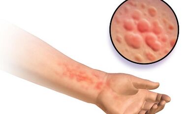 Manifestations of skistosomosis in humans